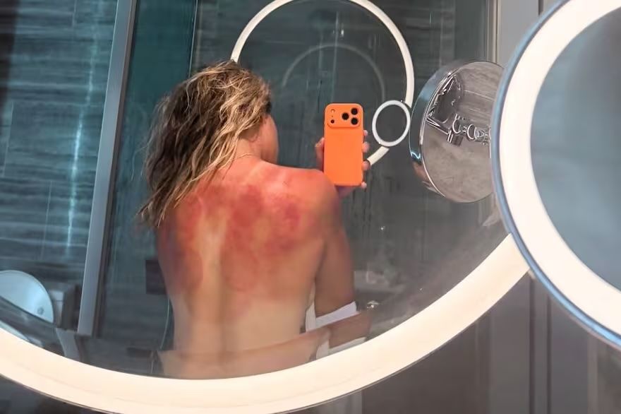 La schiena di Renata Zarazua dopo l'esposizione al sole